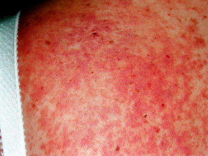 Close-up of skin showing a bright red, blotchy rash across the torso, characteristic of chronic graft-versus-host disease symptoms.