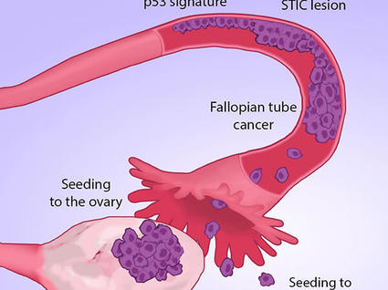 Microscopic view of Ewing sarcoma cells with arrows indicating gene fusions involving the EWS gene.