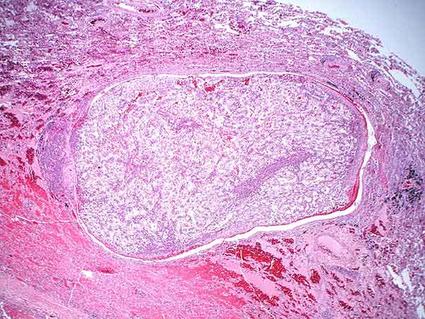 Microscopic pathology slide showing cross-sectional tissue from a kidney tumor, stained pink with distinct cellular patterns and structures visible under magnification.