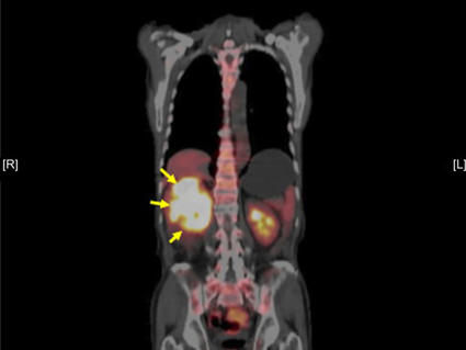 Medical PET scan showing a tumor in the right kidney, highlighted with yellow arrows pointing to the bright yellow-white areas indicating areas of increased metabolic activity typical of cancerous tissue.