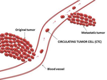Diagram showing how circulating tumor cells (CTCs) break away from the original tumor, travel through the bloodstream, and form a metastatic tumor in another location.