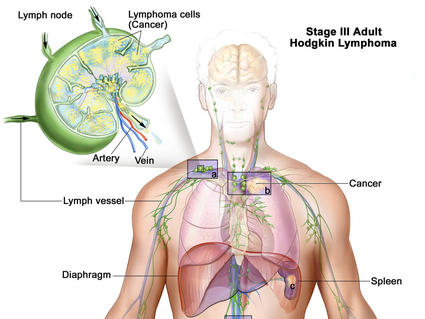 Illustration of Stage III Adult Hodgkin Lymphoma. The image shows the human body with a focus on the lymphatic system. Lymph nodes, vessels, the diaphragm, and spleen are highlighted. Cancerous lymphoma cells are present in lymph nodes above and below the diaphragm. An inset on the left provides a close-up of a lymph node, showing lymphoma cells, arteries, and veins.