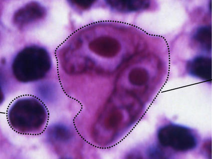 A comparison of normal lymphocytes alongside a Reed-Sternberg Cell. The lymphocyte is a dark purple circle; there are a number of these on a purple and white background. The Reed-Sternberg Cell is a medium-purple, approximately five to six times as large as the lymphocyte, and has three nuclei. 