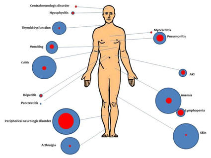 Illustration of a human figure annotated with various medical conditions, each represented by differently sized circles. Larger circles indicate common conditions, and smaller ones indicate rarer issues. Conditions include central neurologic disorder, hypothyroidism, myocarditis, pneumonitis, colitis, hepatitis, pancreatitis, AKI (acute kidney injury), anemia, lymphopenia, and skin-related issues. Lines connect each condition to specific body areas.