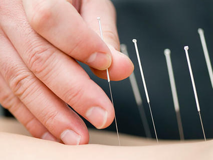 Close-up of acupuncture treatment showing several thin needles inserted into a patient's body, with a practitioner's hand positioned nearby for guidance.