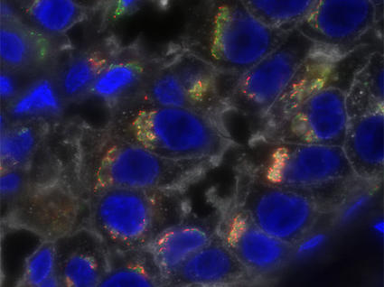 Triple-negative breast cancer cells stained to show profound molecular heterogeneity.
