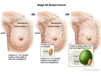 Illustration of Stage IIA Breast Cancer showing three scenarios. The left panel: Cancer is present in 1 to 3 lymph nodes in the axilla or near the breastbone, with no visible tumor in the breast. The middle panel: Tumor is 2 cm or smaller, with cancer in 1 to 3 lymph nodes in the axilla or near the breastbone. An inset shows the size comparison with a peanut. The right panel: Tumor is larger than 2 cm but not larger than 5 cm. An inset compares the size to a lime and a peanut.