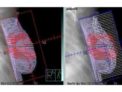 Side-by-side medical imaging scans showing breast radiation therapy planning with highlighted treatment areas and dose grids.