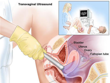 An illustrated cross-section titled “Transvaginal Ultrasound.” In the top right corner is a small illustration in which a nurse holds a transducer inside of a patient who is lying on her back, while the nurse looks at a computer screen with the ultrasound image. The larger cross section shows the transducer around surrounding anatomy, labeling the bladder, uterus, ovary, fallopian tube, and rectum. 