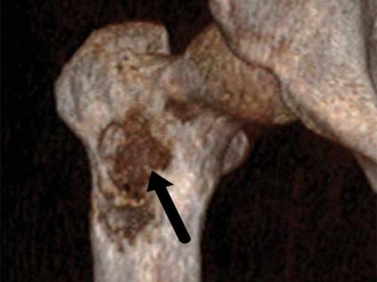 CT scan of a femur with cancer.