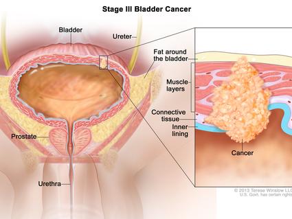 Illustration labeled “Stage III Bladder Cancer.” The main illustration labels the bladder, ureter, fat around the bladder, urethra, and prostate. A small cancer cluster inside of the muscle and fat layers of the bladder is linked to an inset illustration which labels the muscle layers, connective tissue, and inner lining of the bladder along with the actual cancer. 