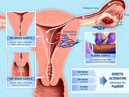 Illustration of how PapSEEK detects genetic alterations in endometrial and ovarian cancers using samples from Tao brush, Pap brush, and blood plasma.