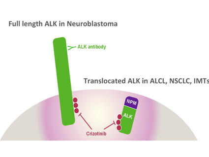 Diagram showing full-length ALK in neuroblastoma targeted by an antibody, and translocated ALK in ALCL, NSCLC, and IMTs inhibited by Crizotinib.
