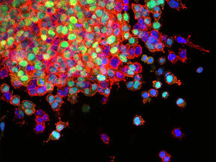 Lung cancer cells invade surrounding tissues and start to spread (metastasis).