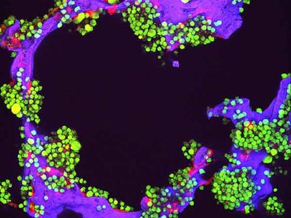 Fluorescent microscope image showing green myeloma tumor cells and red bone cells growing on a purple laboratory-made scaffold, used for research purposes.