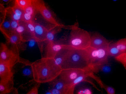 Photo of human breast cancer cells