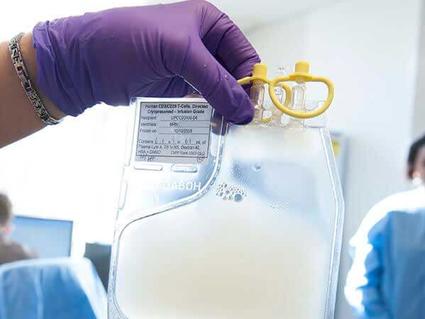 Person wearing a purple glove holds a transparent bag filled with a milky white liquid, the manufactured CAR T cells. The bag has yellow caps and a label with information.