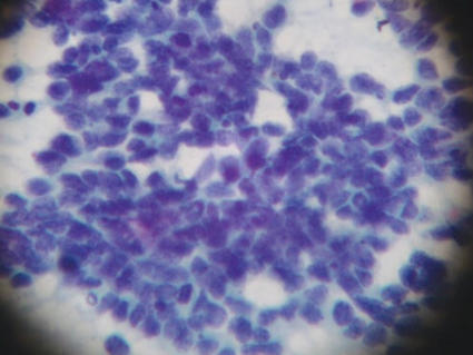 Image of small cell lung cancer cells
