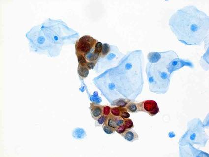 A pathology slide of a cervical tissue sample showing brown (p-16) and red (Ki-67) staining.