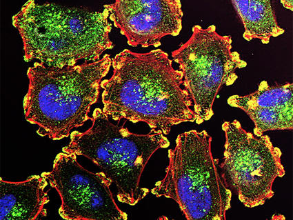 Fluorescence microscopy image of metastatic melanoma cells, with blue-stained nuclei, green-stained organelles, and red-highlighted cell membranes, illustrating cellular structure and protein distribution.