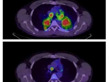 Before and after PET scan of patient treated with crizotinib.