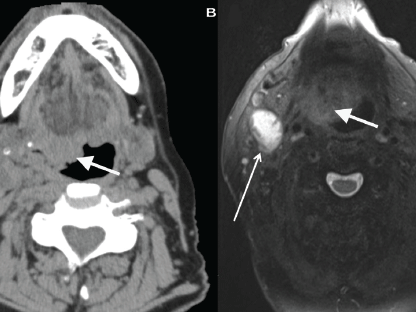 Three images of a patient with an HPV-positive oropharyngeal tumor. The first two are black and white; so is the last one, but it includes shades of red and yellow. In the middle, an arrow points at a large white shape. On the right, a different arrow points to a large yellow-white shape near the location of the white shape in the previous panel.