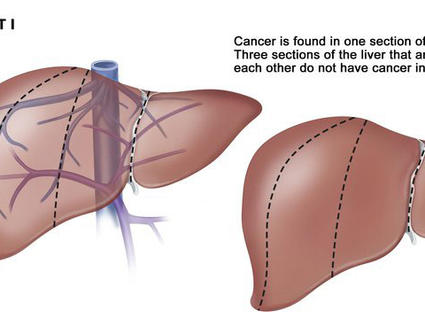 Illustration titled “Liver PRETEXT I”. Two depictions of the liver are side by side. The left labels a mass of cancer on the liver and shows veins behind the liver. The right shows the cancer mass in a different position on the liver and doesn’t show any veins. Above both illustrations, text reads “Cancer is found in one section of the liver. Three sections of the liver that are next to each other do not have cancer in them.”