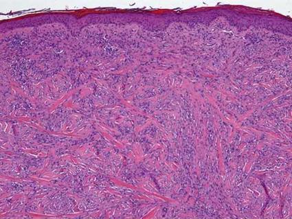 Microscopic image of desmoplastic melanoma showing spindle-shaped tumor cells embedded in dense, fibrous tissue stained in pink and purple.