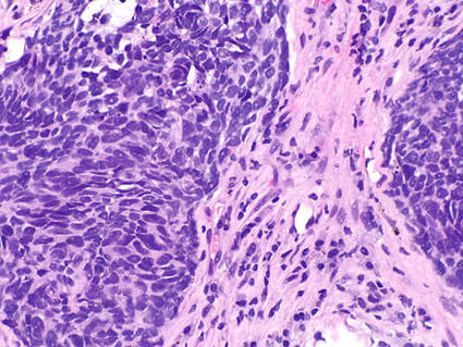 Microscopic tissue sample showing nonsquamous non-small cell lung cancer cells with purple-pink staining, displaying irregular cellular structure and abnormal growth patterns.