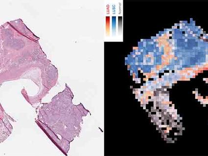 Side-by-side images of lung tissue: left shows stained slide, right shows AI-labeled cancer and normal regions.