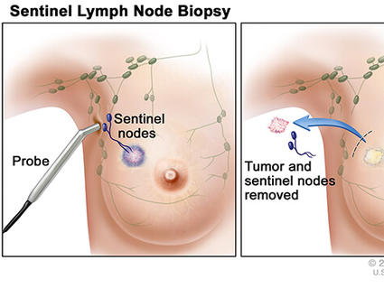 Illustration showing a three-step procedure for sentinel lymph node biopsy in breast cancer treatment. The first panel depicts an injection of a radioactive substance or dye near a tumor to identify lymph nodes. The second panel shows a probe detecting sentinel nodes. The third panel illustrates the removal of the tumor and sentinel nodes.