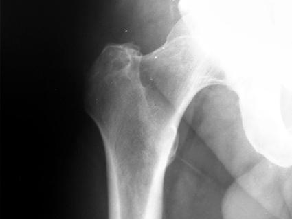 X-ray image showing the hip and upper thigh bone area, revealing a metastatic tumor that has spread to the bone tissue.
