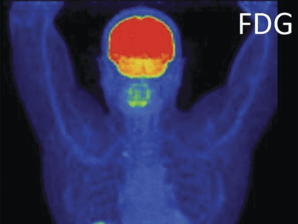 An FDG-PET scan shows a human figure from the front, highlighting areas of metabolic activity in various colors. Bright areas in red and yellow indicate higher activity, particularly in the brain, abdomen, and bladder.