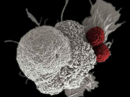 Electron microscope image showing red cytotoxic T cells attacking a white oral squamous cancer cell, demonstrating how immune checkpoint inhibitors help T cells destroy tumor cells.