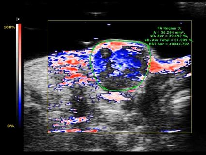 Photoacoustic ultrasound image displaying oxygen distribution (shown in red) within tumor tissue following microbubble delivery, with blue and white regions indicating other tissue characteristics and measurement data displayed on the screen.