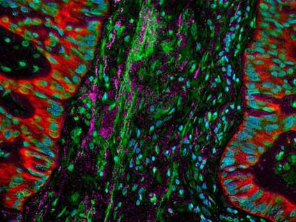 Fluorescent microscope image of a lung tumor showing cancer cells in red with green and blue highlighting other cellular structures and tissue components.