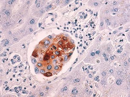 Microscopic image of liver tissue showing metastatic breast cancer cells highlighted in brown staining, surrounded by normal liver tissue with blue-stained nuclei.