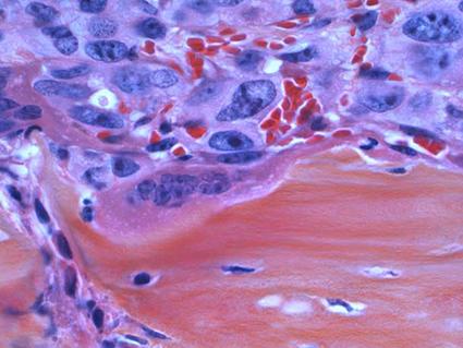 Microscopic image showing cancer cells (purple) invading bone tissue (orange), demonstrating how prostate cancer metastasizes to bone causing pain and structural damage.