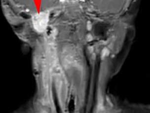 Four MRI images showing before (A, B) and after (C, D) treatment of infantile fibrosarcoma with larotrectinib, demonstrating significant tumor reduction in the neck and oral cavity areas marked with red arrows.