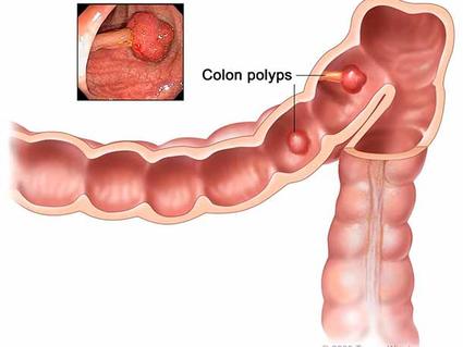 Close-up illustration of a section of the colon with two polyps, which are labeled. A small inset photograph in the top left shows a photo of a colon polyp.