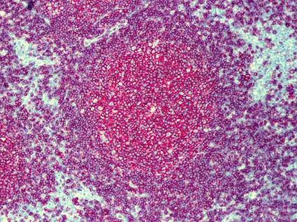 Microscopic pathology slide of follicular lymphoma tissue, stained in purple and pink, showing the characteristic follicular pattern of this type of cancer.