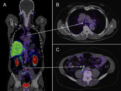 PSMA PET-CT images of a man with prostate cancer show metastases in lymph nodes in the chest and abdomen.