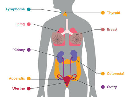 An illustration highlighting organs in which cancers were detected by an experimental blood test.