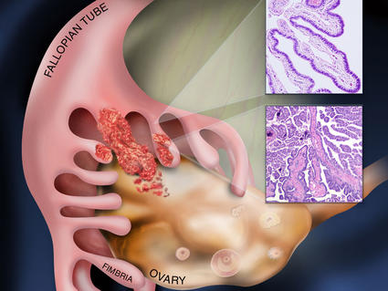 Illustration showing ovarian cancer starting in the fallopian tube