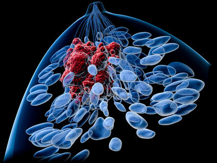 Top view of a female breast with a tumor. Inside of a blue body silhouette, lobules, lactiferous ducts (also blue) and a tumor (in red) can be seen. The background is black.