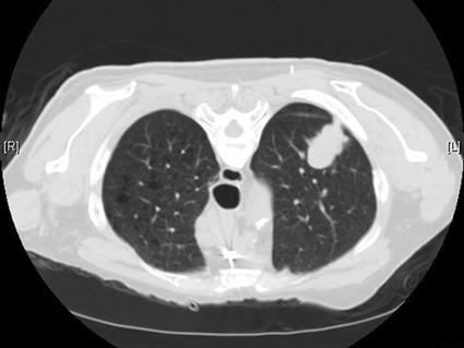 CT scan showing a cross-section of the chest with a large white mass in the left lung, indicating a tumor.