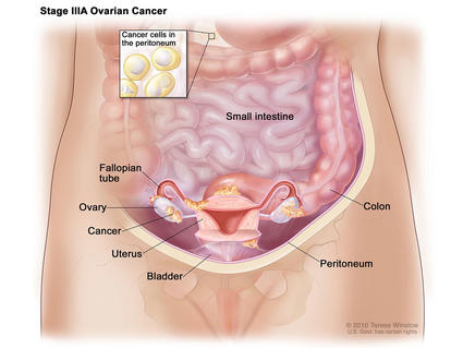 Illustration titled “Stage IIIA Ovarian Cancer” which focuses on the stomach, labeling the small intestine, colon, peritoneum, bladder, uterus, ovary, and fallopian tube. Cancer is also labeled and is present on the ovary, fallopian tube, bladder, and colon. A small inset box towards the top reads “Cancer cells in the peritoneum” showing a few yellow cancer cells. 