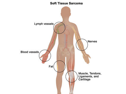An illustration of the human body titled “Soft Tissue Sarcoma.” The body is in silhouette and has labels for various parts of the human body which are illustrated to mimic the look of each part. The labels read “Nerves”, “Muscle, Tendons, Ligaments and Cartilage”, “Fat”, “Blood Vessels”, and “Lymph Vessels.”