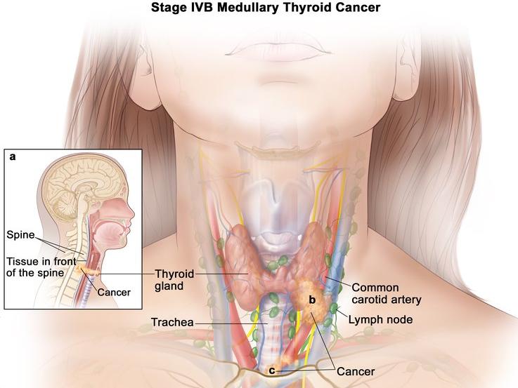 tirzepatide and medullary thyroid cancer Selpercatinib Approved for Thyroid and Lung Cancers