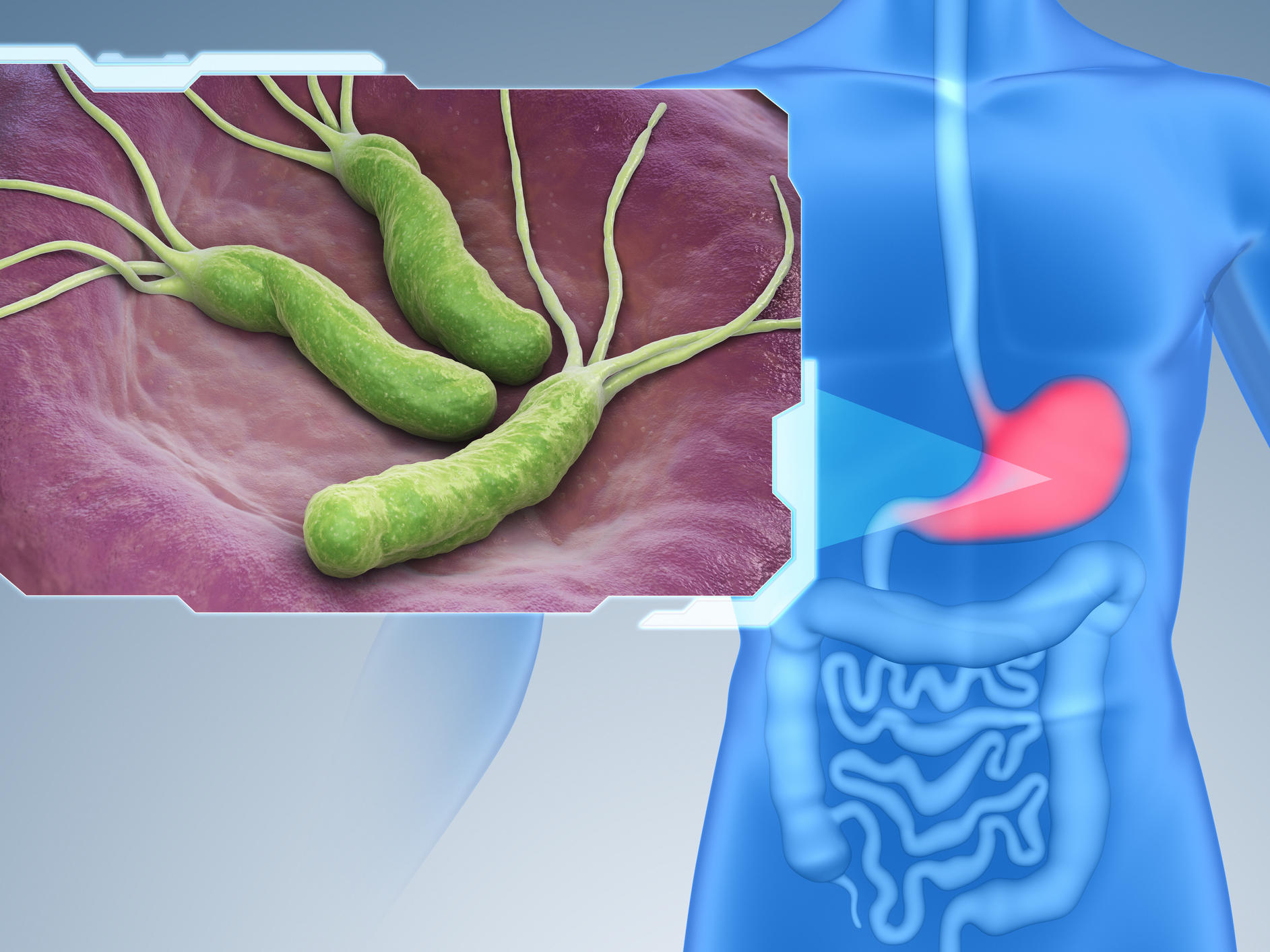 Helicobacter pylori (H. pylori) and Cancer - NCI